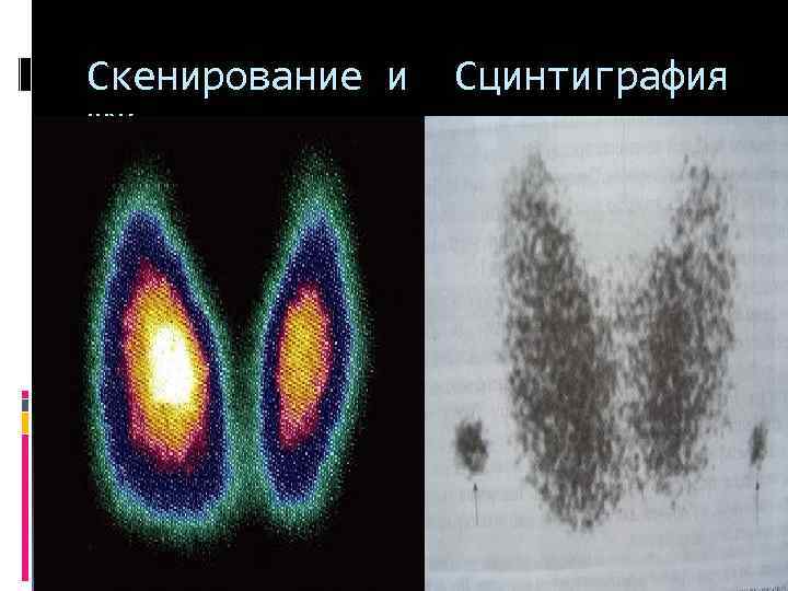 Скенирование и Сцинтиграфия ЩЖ 