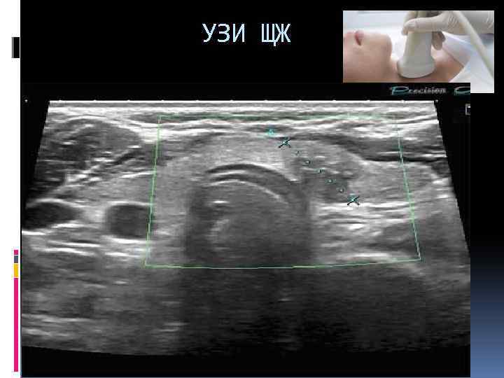  УЗИ ЩЖ 