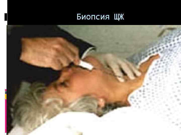  Биопсия ЩЖ 