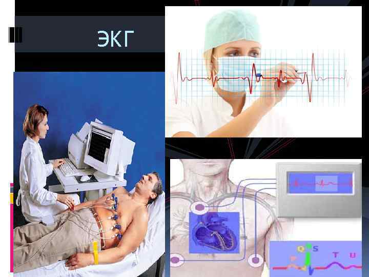  ЭКГ 