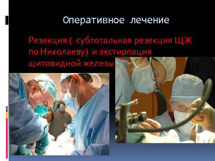  Оперативное лечение Резекция ( субтотальная резекция ЩЖ по Николаеву) и экстирпация щитовидной железы
