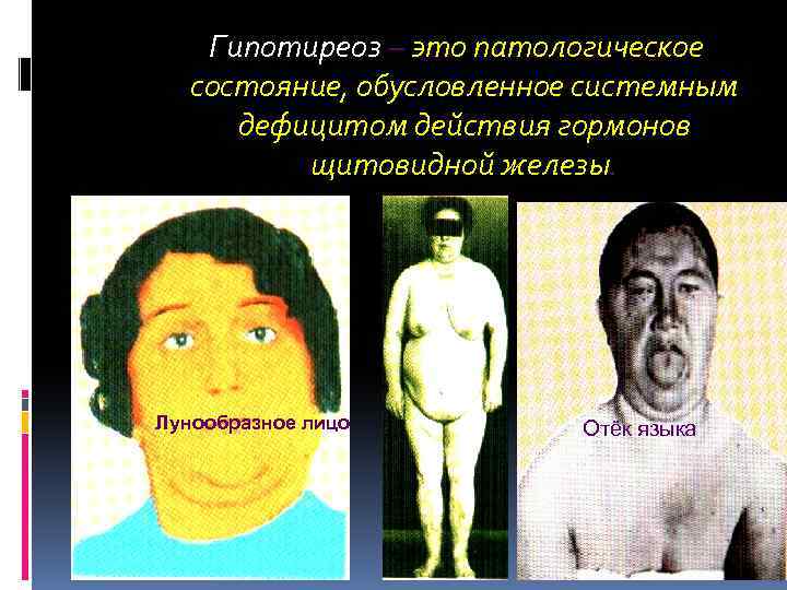  Гипотиреоз – это патологическое состояние, обусловленное системным дефицитом действия гормонов щитовидной железы. Лунообразное
