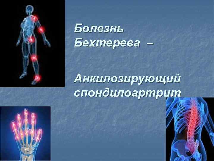 Болезнь Бехтерева – Анкилозирующий спондилоартрит 