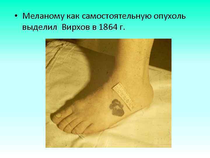  • Меланому как самостоятельную опухоль выделил Вирхов в 1864 г. 