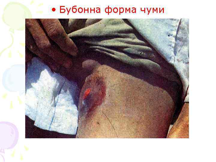  • Бубонна форма чуми 