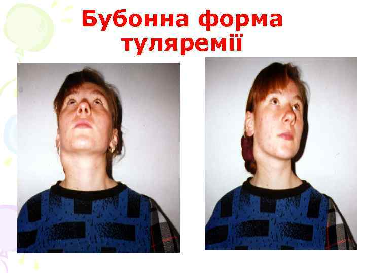 Бубонна форма туляремії 