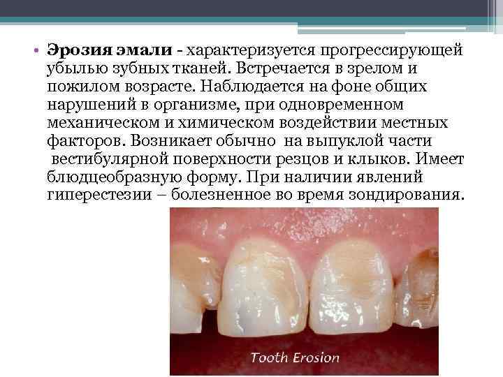  • Эрозия эмали - характеризуется прогрессирующей убылью зубных тканей. Встречается в зрелом и