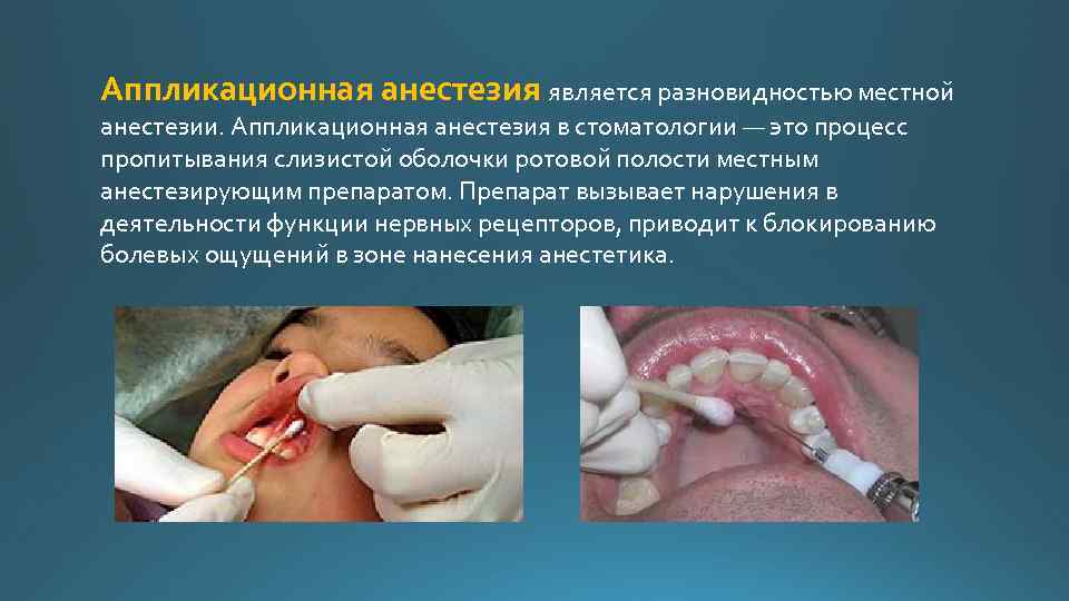 местная анестезия в стоматологии местная анестезия anaesthesia. . . аппликационная анестезия является разновидностью мес