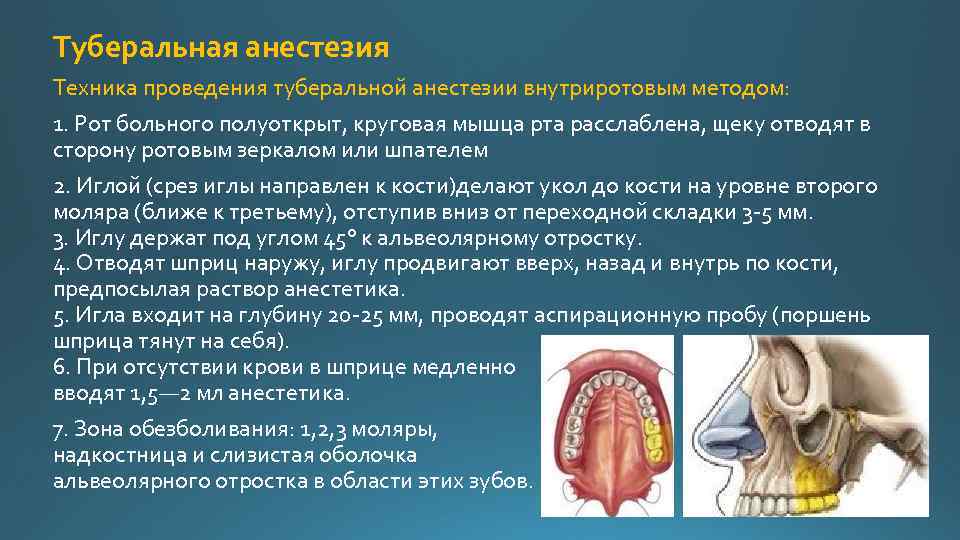 Онемения после анестезии. Туберальная анестезия техника. Туберальная анестезия в стоматологии. Туберальная анестезия в стоматологии техника проведения. Туберальная анестезия зона обезболивания.