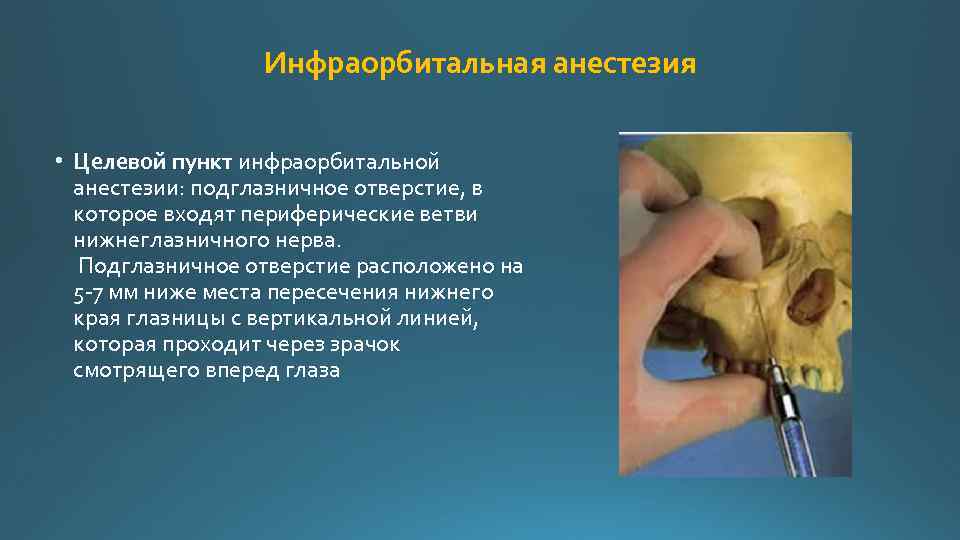 Местная анестезия картинки