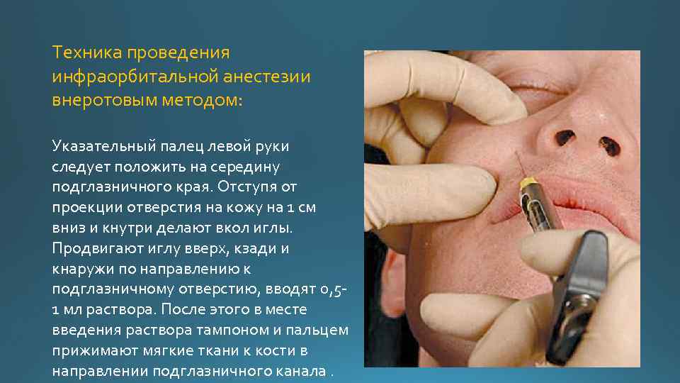 местная анестезия в стоматологии местная анестезия anaesthesia. . . техника проведения инфраорбитальной анестезии внерот