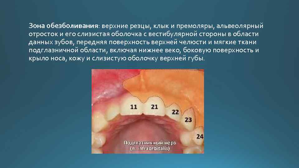 Зона обезболивания: верхние резцы, клык и премоляры, альвеолярный отросток и его слизистая оболочка с