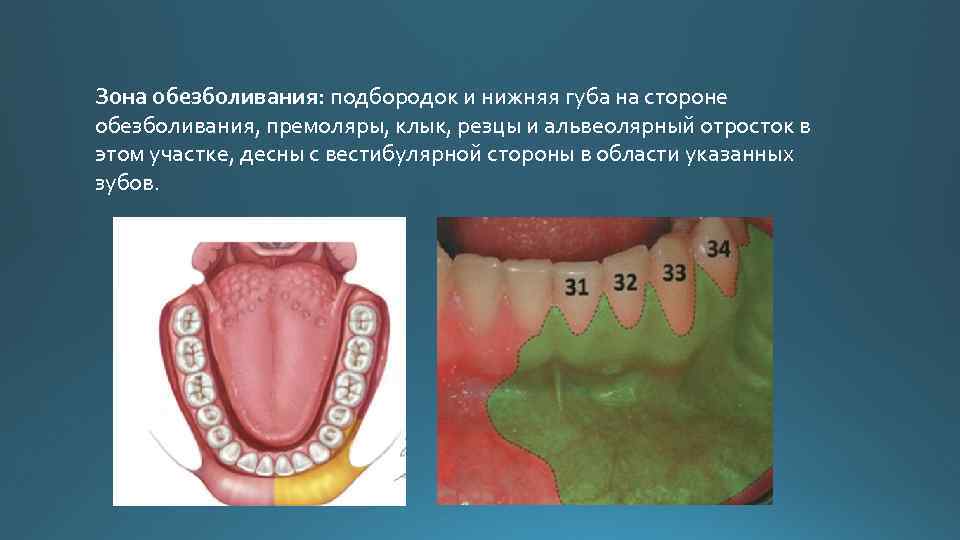 Зона обезболивания: подбородок и нижняя губа на стороне обезболивания, премоляры, клык, резцы и альвеолярный