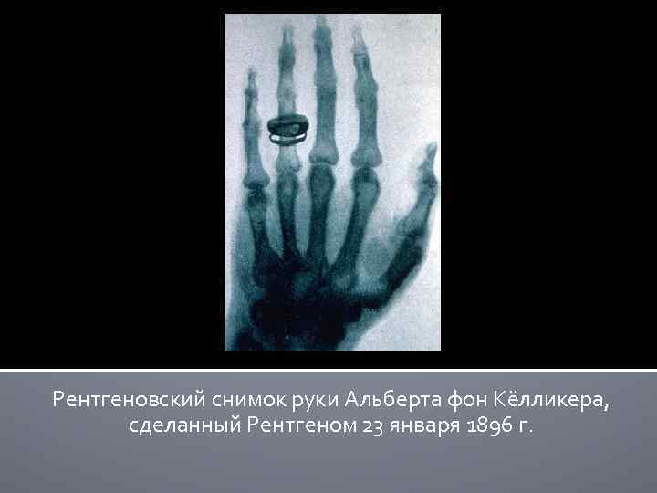 Рентгеновский снимок руки Альберта фон Кёлликера, сделанный Рентгеном 23 января 1896 г. 