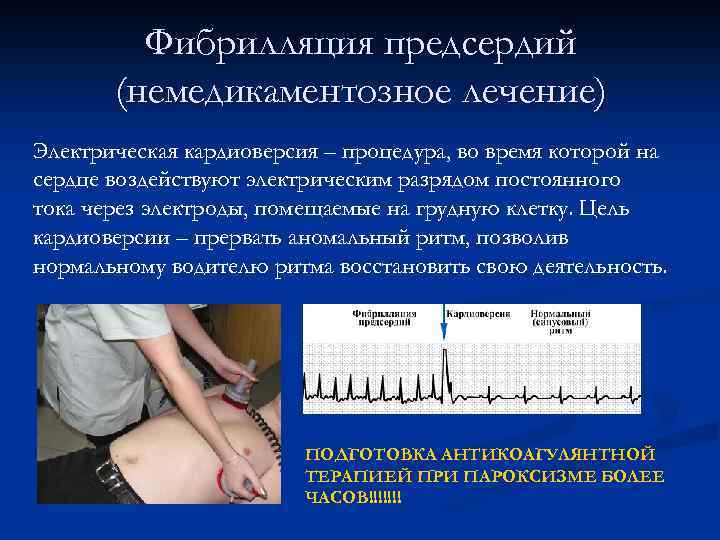 Фибрилляция предсердий лечение