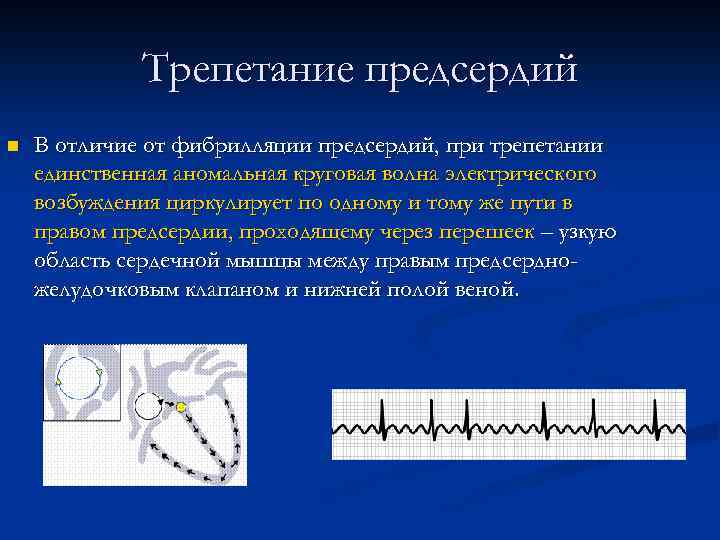 Трепетание предсердий n В отличие от фибрилляции предсердий, при трепетании единственная аномальная круговая волна