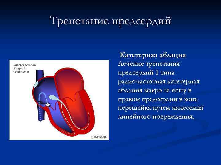 Особенности предсердия. Проводящая система сердца. РЧА трепетания предсердий. Нарушение функции предсердия. Движение крови из предсердия в желудочек регулируют.