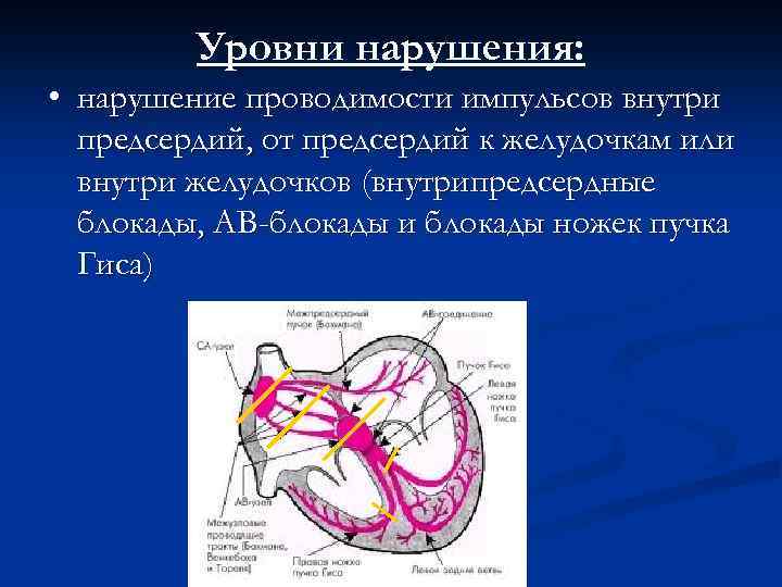 Замедление проводимости по ножке пучка гиса