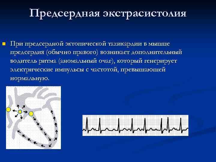 Предсердная экстрасистолия n При предсердной эктопической тахикардии в мышце предсердия (обычно правого) возникает дополнительный