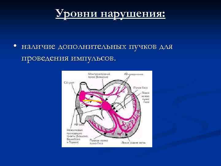 Уровни нарушения: • наличие дополнительных пучков для проведения импульсов. 