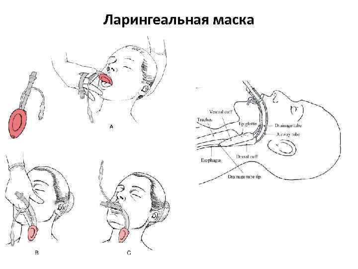 Опыт использования ларингеальных масок в анестезии у детей при хирургических вмешательствах