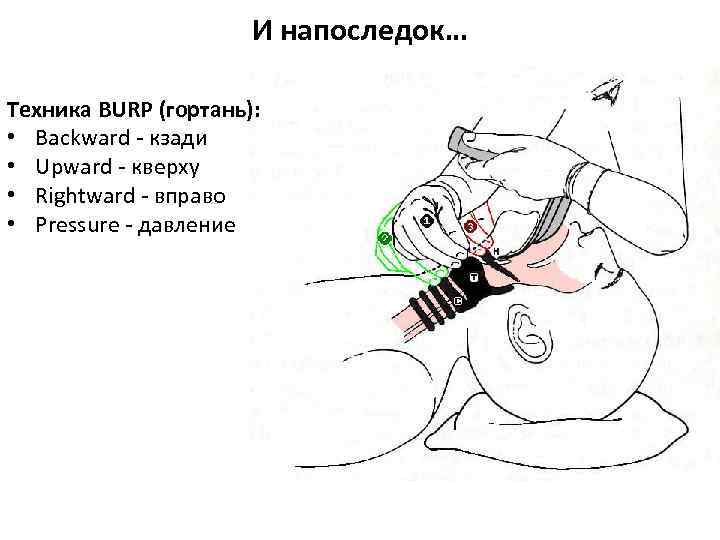 И напоследок… Техника BURP (гортань): • Backward - кзади • Upward - кверху •