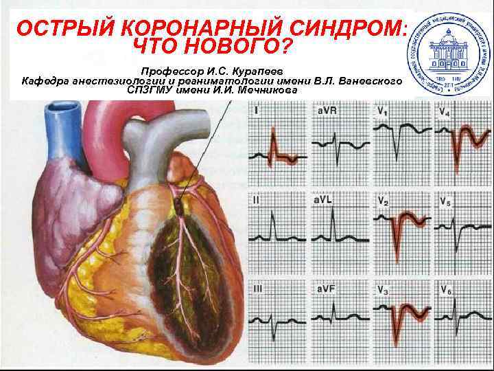 ОСТРЫЙ КОРОНАРНЫЙ СИНДРОМ: ЧТО НОВОГО? Профессор И. С. Курапеев Кафедра анестезиологии и реаниматологии имени