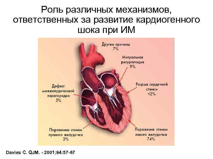 Роль различных механизмов, ответственных за развитие кардиогенного шока при ИМ Davies C. QJM. -