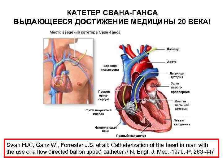 КАТЕТЕР СВАНА-ГАНСА ВЫДАЮЩЕЕСЯ ДОСТИЖЕНИЕ МЕДИЦИНЫ 20 ВЕКА! Swan HJC, Ganz W. , Forrester J.