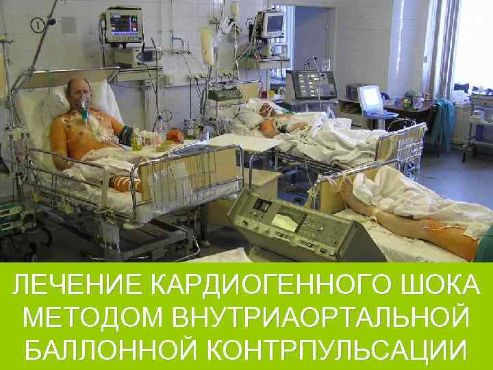 ЛЕЧЕНИЕ КАРДИОГЕННОГО ШОКА МЕТОДОМ ВНУТРИАОРТАЛЬНОЙ БАЛЛОННОЙ КОНТРПУЛЬСАЦИИ 