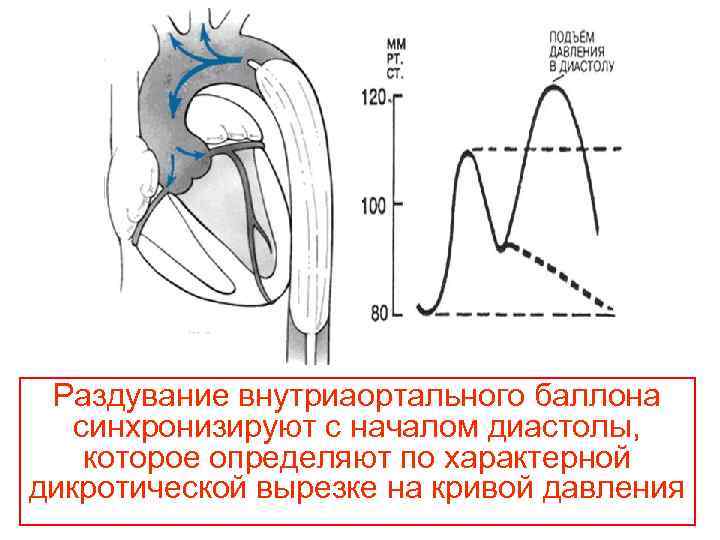 Раздувание внутриаортального баллона синхронизируют с началом диастолы, которое определяют по характерной дикротической вырезке на