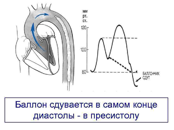 Баллон сдувается в самом конце диастолы в пресистолу 