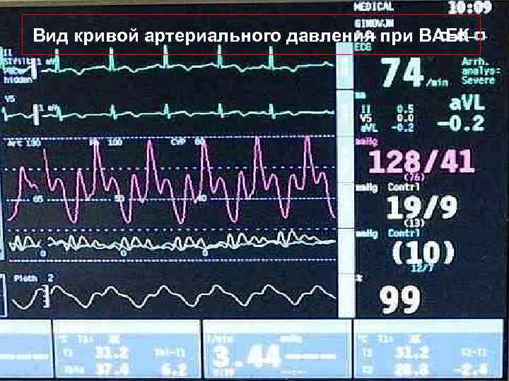 Вид кривой артериального давления при ВАБК 