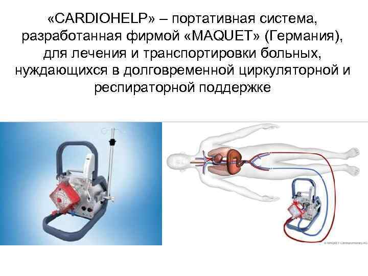  «CARDIOHELP» – портативная система, разработанная фирмой «MAQUET» (Германия), для лечения и транспортировки больных,