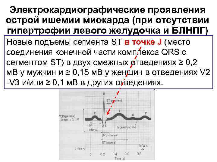 Электрокардиографические проявления острой ишемии миокарда (при отсутствии гипертрофии левого желудочка и БЛНПГ) Новые подъемы