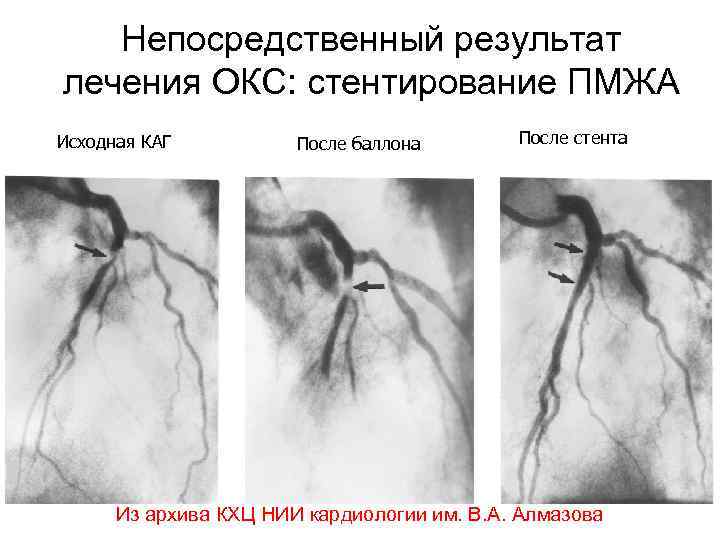 Непосредственный результат лечения ОКС: стентирование ПМЖА Исходная КАГ После баллона После стента Из архива