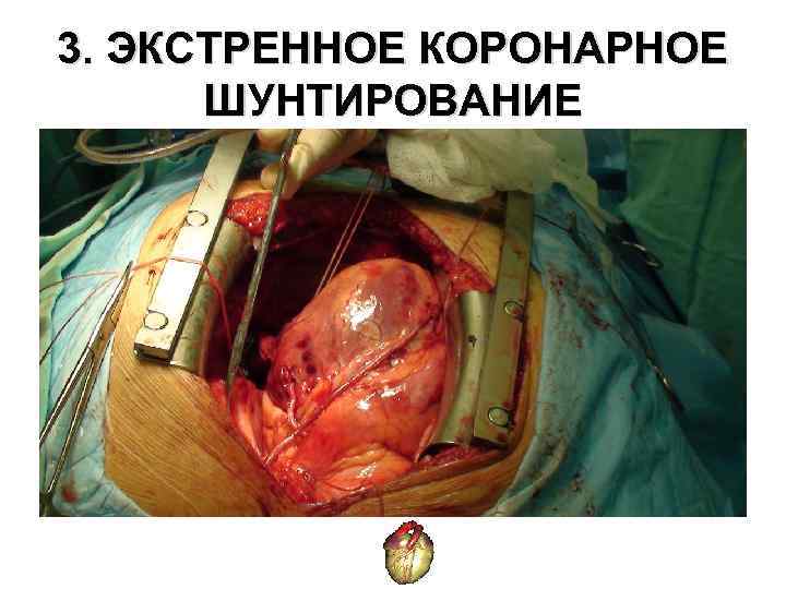 3. ЭКСТРЕННОЕ КОРОНАРНОЕ ШУНТИРОВАНИЕ 