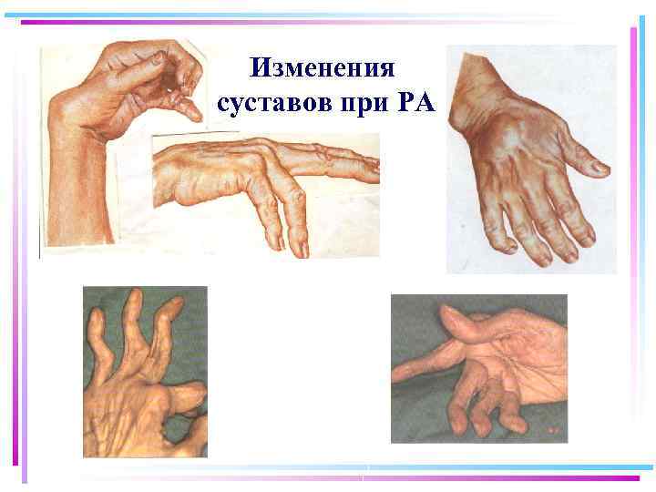 Изменения суставов при РА 