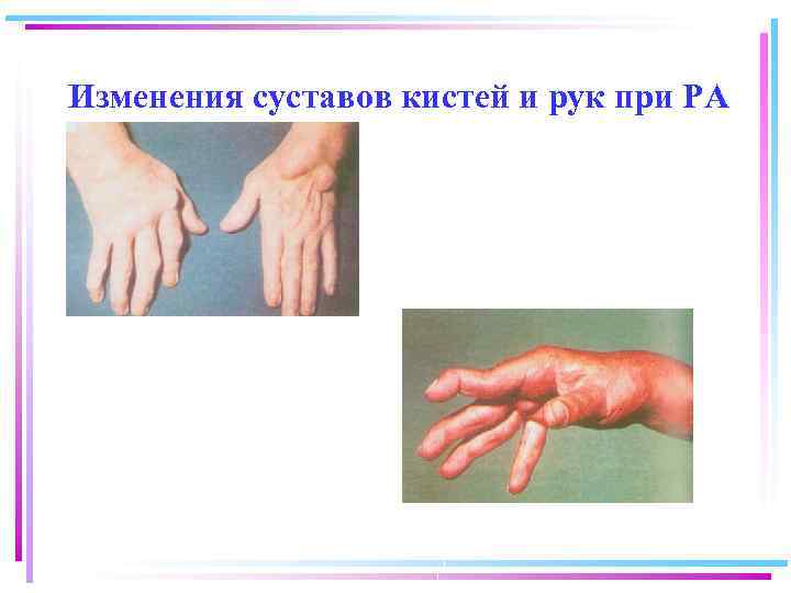 Изменения суставов кистей и рук при РА 