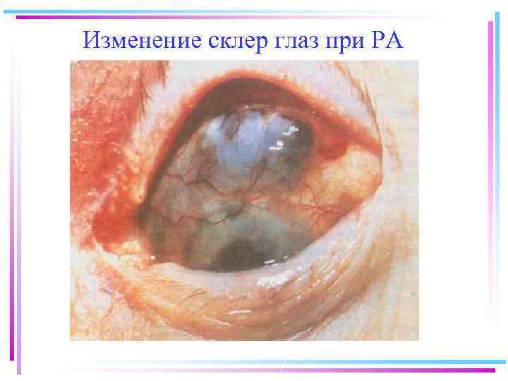 Изменение склер глаз при РА 