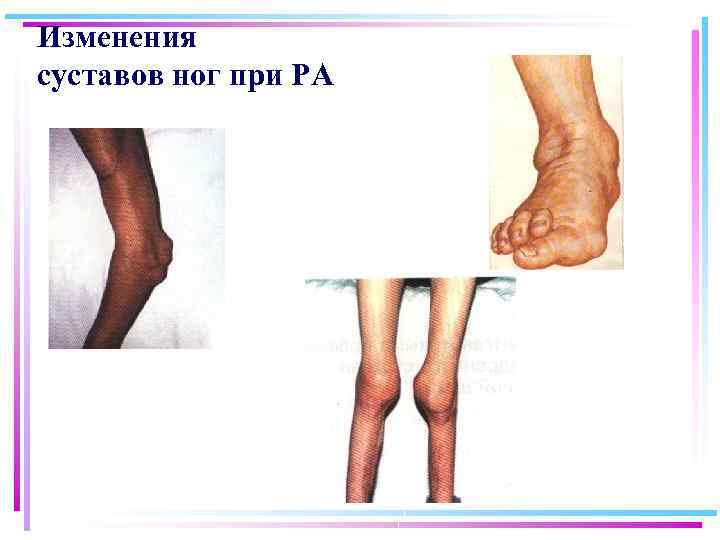 Изменения суставов ног при РА 