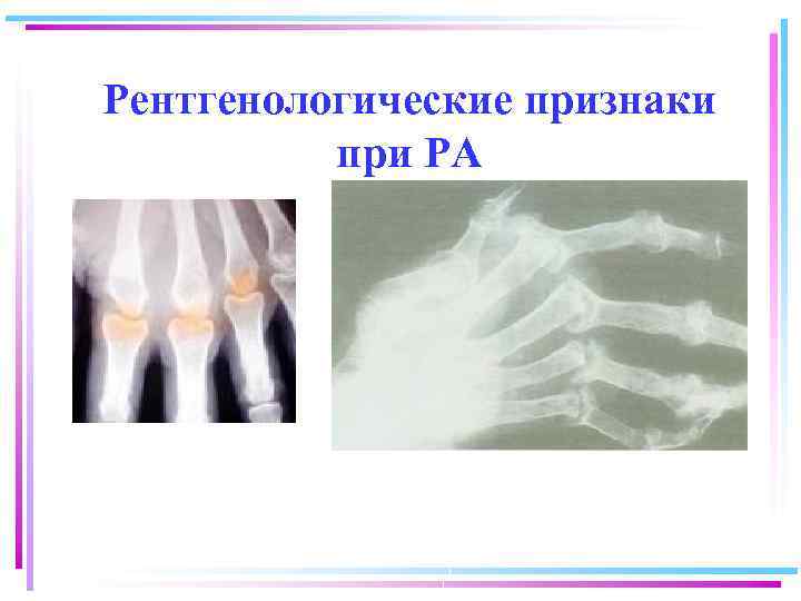 Рентгенологические признаки при РА 