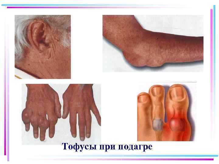Тофусы при подагре 