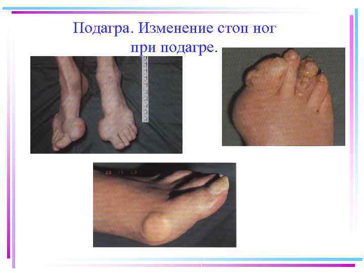 Подагра. Изменение стоп ног при подагре. 