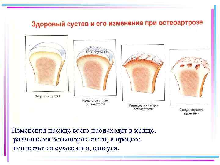 Изменения прежде всего происходят в хряще, развивается остеопороз кости, в процесс вовлекаются сухожилия, капсула.