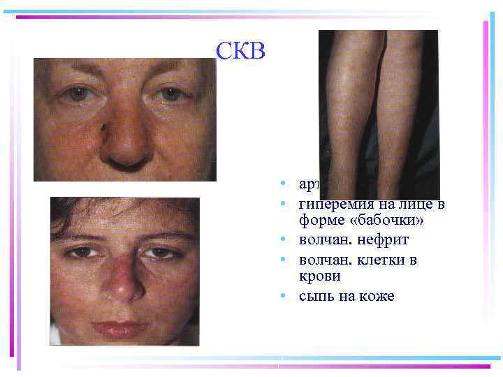 СКВ • артралгии • гиперемия на лице в форме «бабочки» • волчан. нефрит •