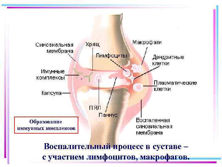 Образование иммунных комплексов Воспалительный процесс в суставе – с участием лимфоцитов, макрофагов. 