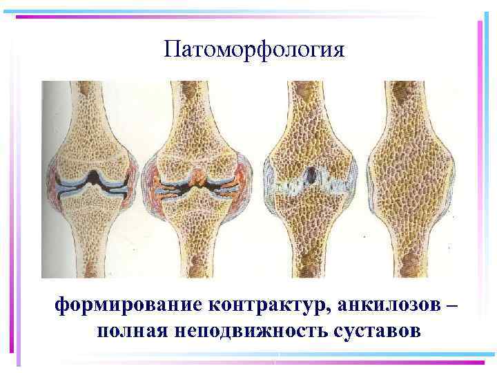 Патоморфология формирование контрактур, анкилозов – полная неподвижность суставов 