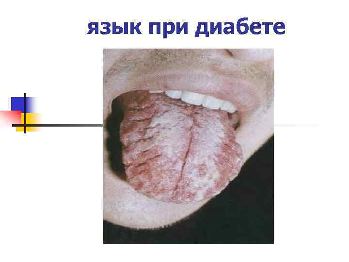 язык при диабете 