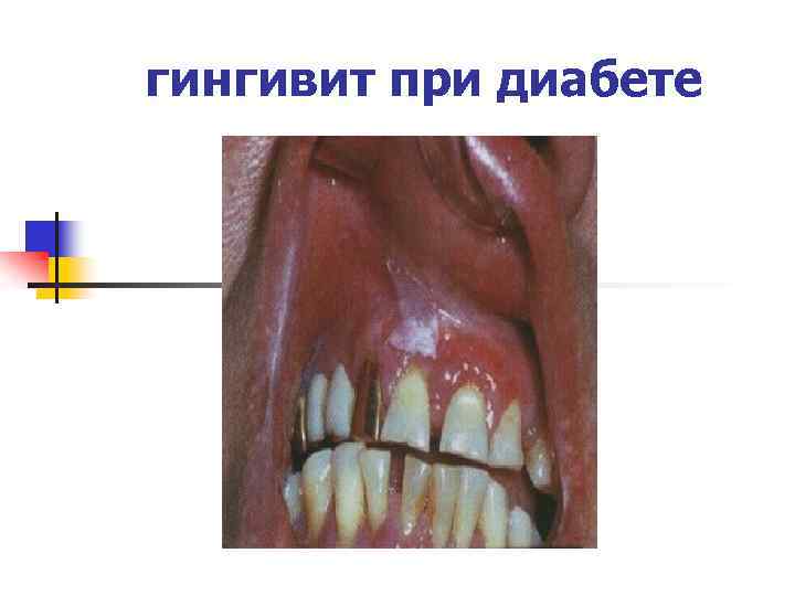 гингивит при диабете 